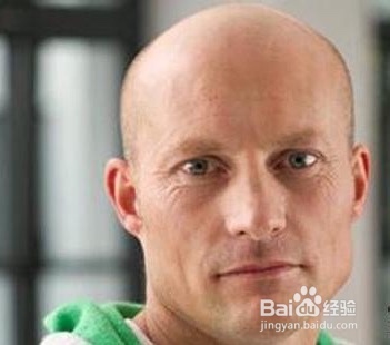 溢脂性脱发怎么治疗？