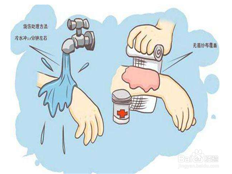 严重烫伤应该如何急救