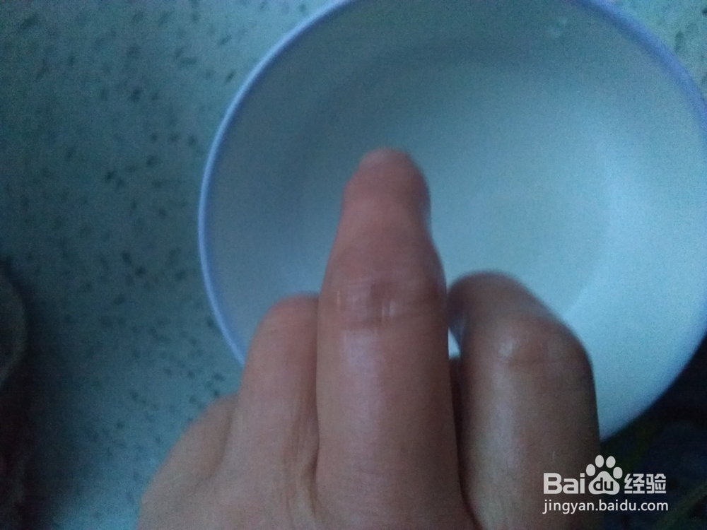 马蜂蜇人的治疗高招