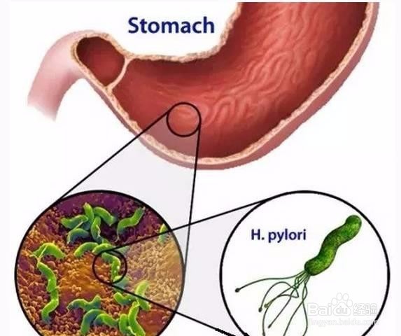 长白山药谷丁香茶可以抑制幽门螺旋杆菌吗