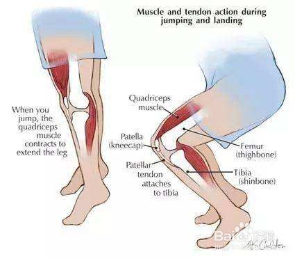 为什么会髌骨软化