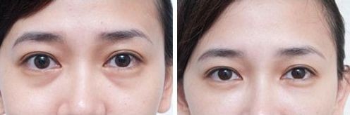 关于调Q激光的注意事项