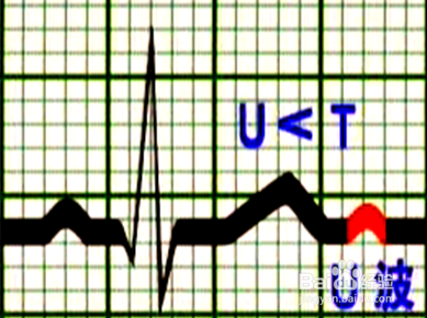 心电图各种波段解析
