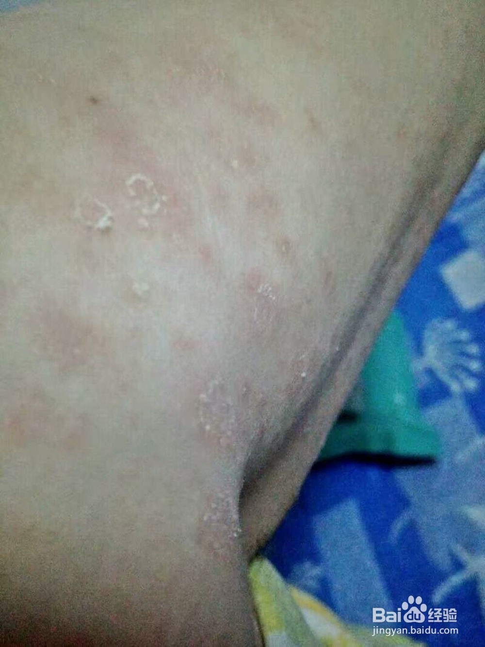 不吃药治疗玫瑰糠疹的正确方法