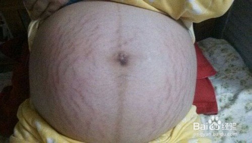 如何去除妊娠纹 我的个人经历分享