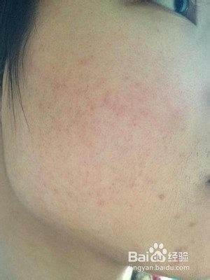 脸部过敏怎么办