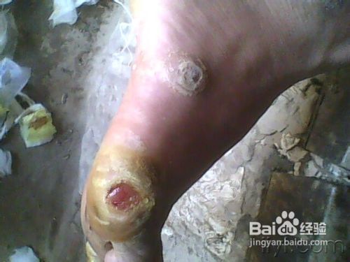 治疗冻脚的偏方