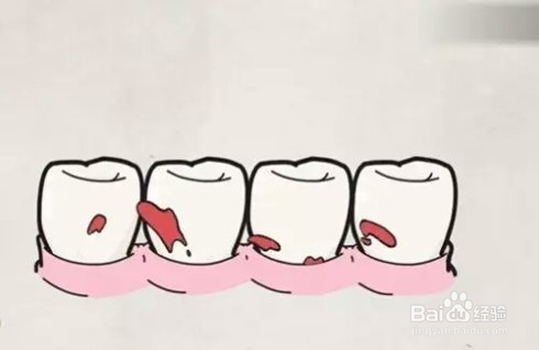 牙龈经常出血怎么办？