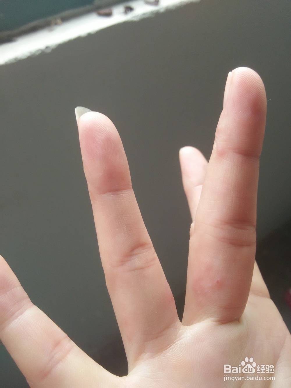 分享手上长水泡如何治愈的方法