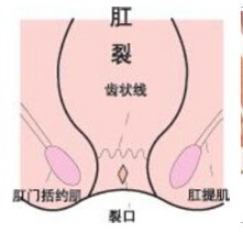 肛裂如何自愈