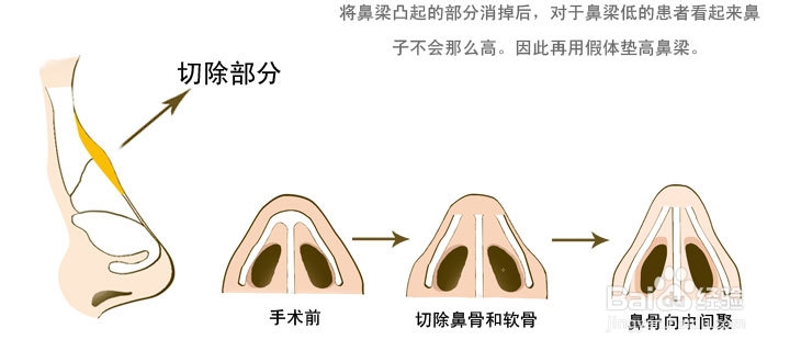 驼峰鼻矫正解决方案