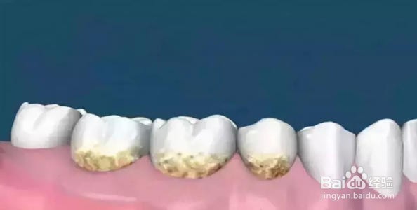 牙结石，牙垢怎么清除？