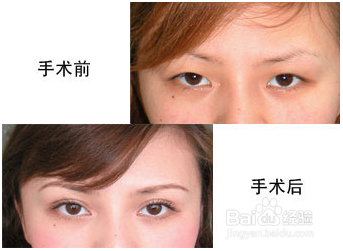 做双眼皮手术能维持多久