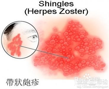 带状疱疹分析及中西医快速疗法