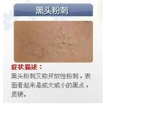 世上最全面治疗痘痘大全