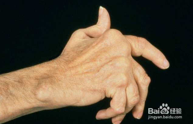 腰肌劳损怎么恢复?得了腰肌劳损怎么办?