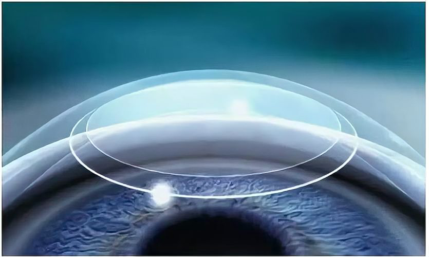 佩戴角膜塑形镜在四川司法警官职业学院里面被发现了会开除吗