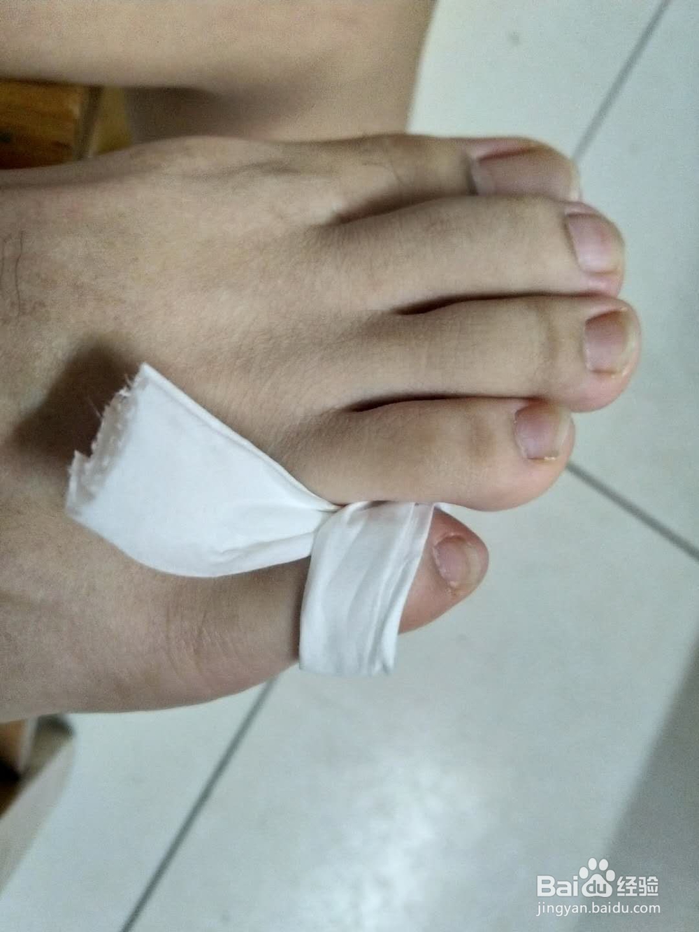 巧妙解决脚趾间破皮疼痛问题