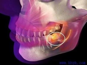 长智齿的了怎么办