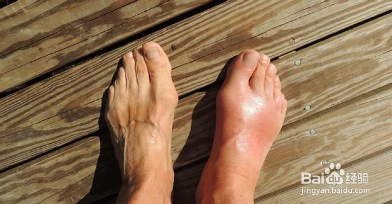 高尿酸对身体有哪些危害?