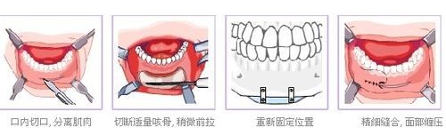 垫下巴整形适用人群