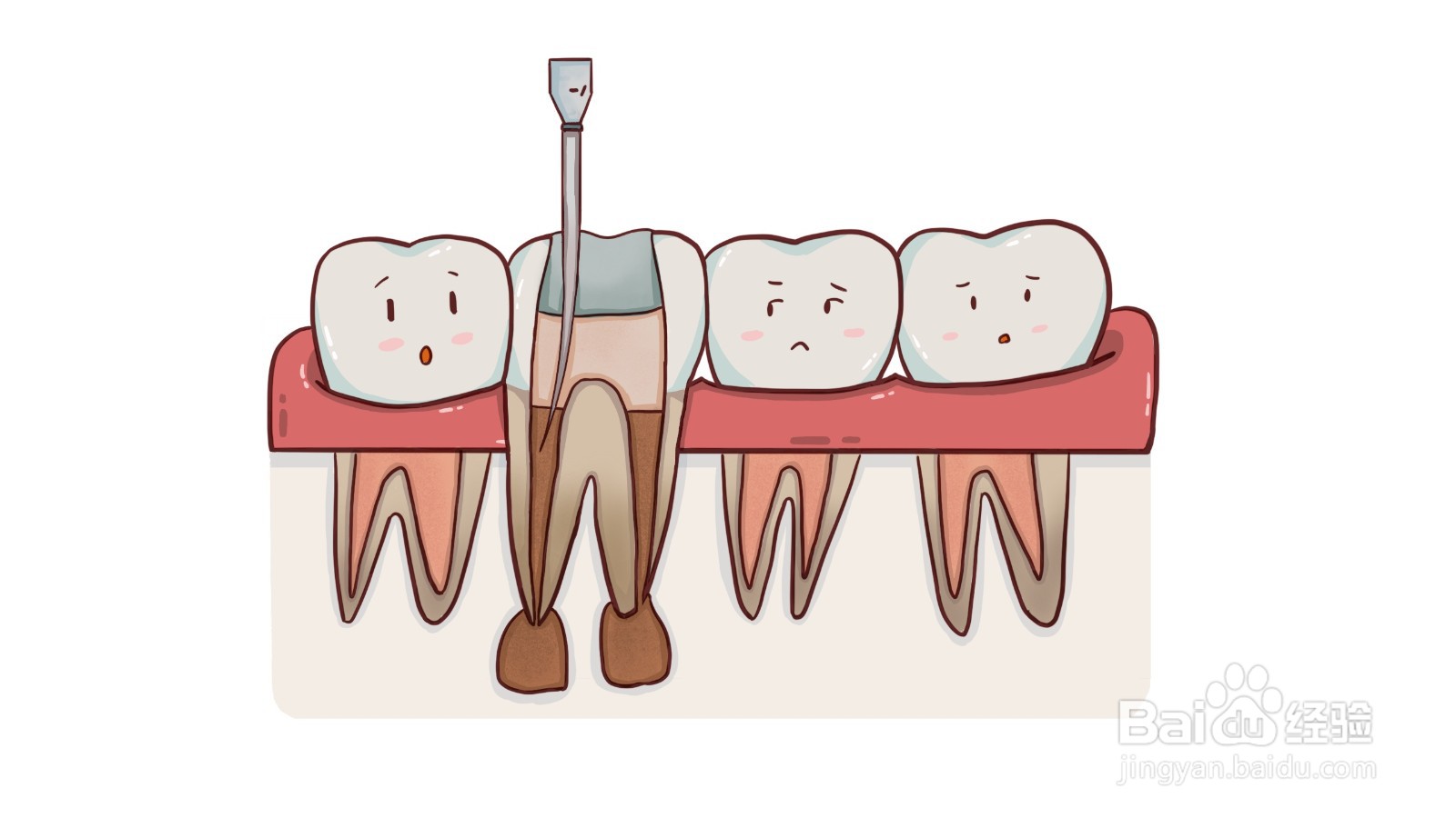 什么是根管治疗？有什么危害？