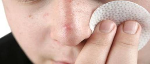 教你挤痘如何不留疤