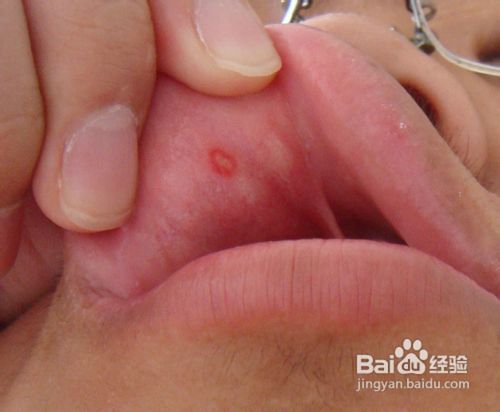 远离口腔溃疡“火”不得