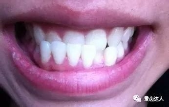 为什么牙齿需要矫正?