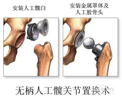 股骨头坏死置换手术易引起哪些并发症