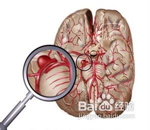 关注健康 血小板增多症的症状有哪些