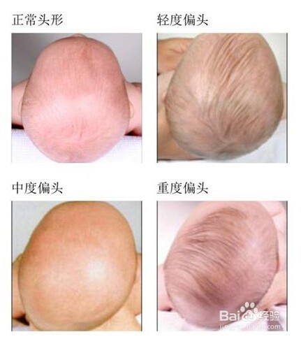 调整宝宝头型，怎样防止宝宝把头睡偏？