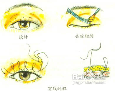 单眼皮变双眼皮，小眼睛变大眼睛