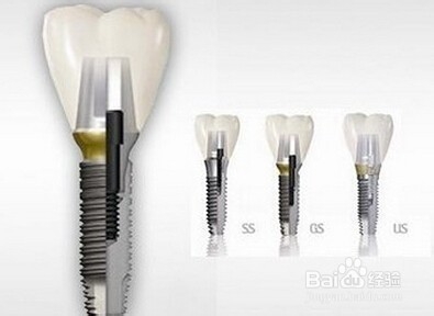 种植牙的利与弊