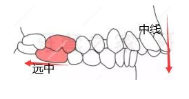 安氏一类二类三类怎样分