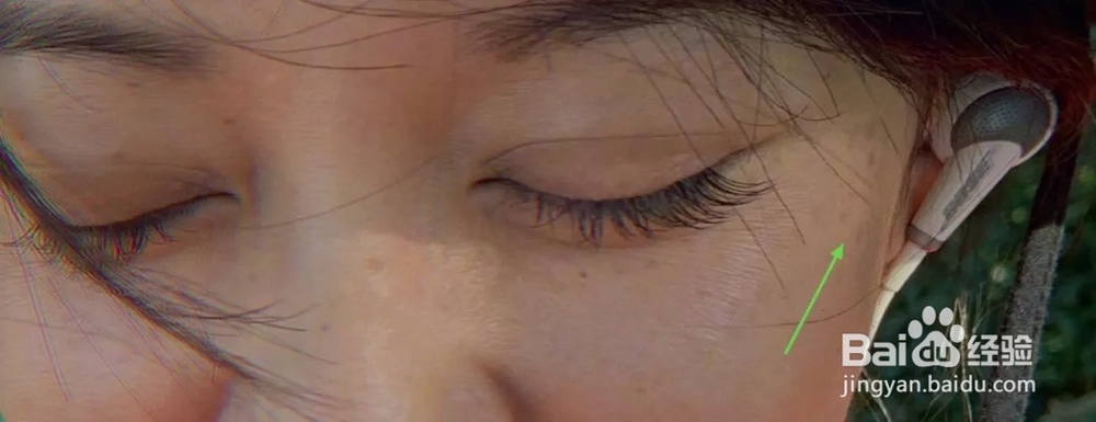 壬二酸可以治疗痤疮和淡化色斑吗？