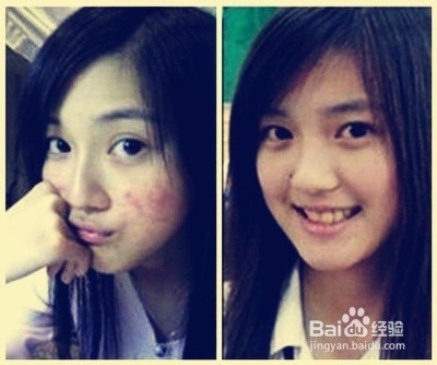 痘痘与肝脏的关系非同一般