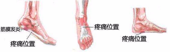 如何避免筋膜炎的发生