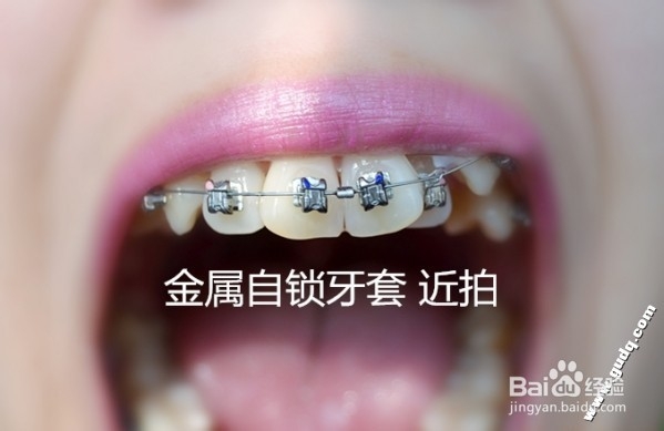 牙齿矫正：[2]带牙套的第二天的感受