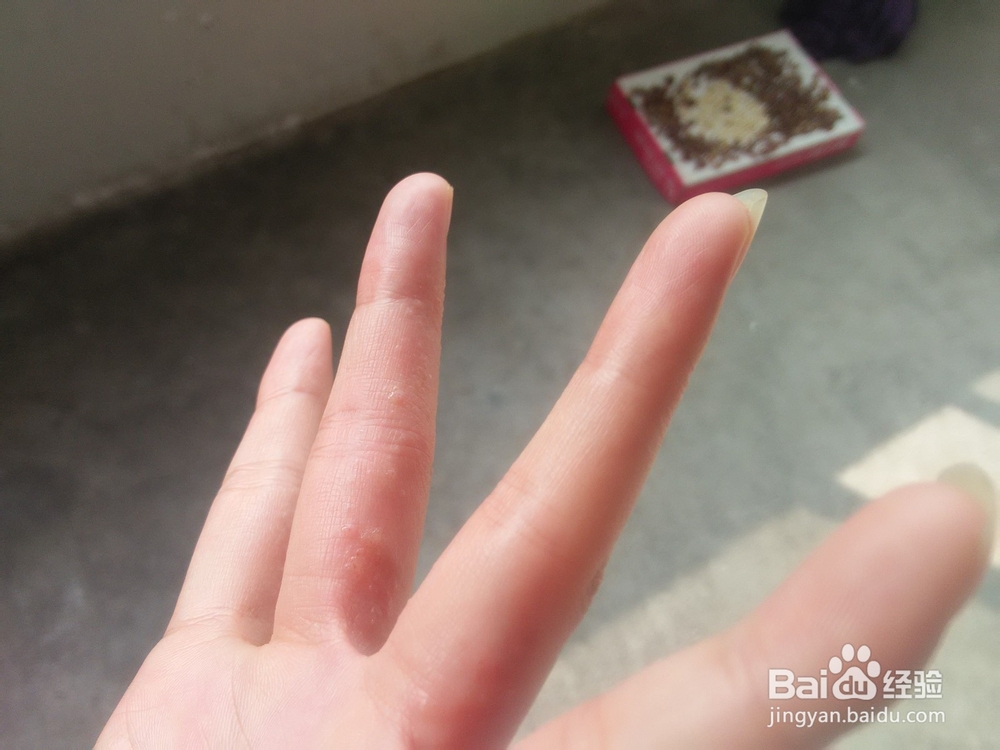 分享手上长水泡如何治愈的方法