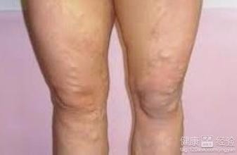 静脉曲张简介、预防、治疗