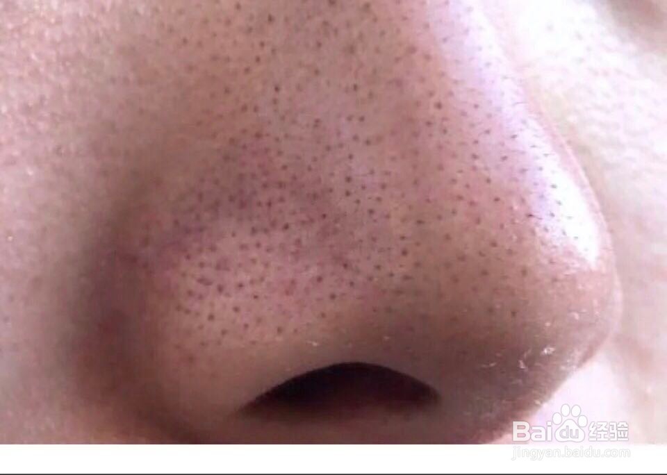 怎么去黑头收缩毛孔