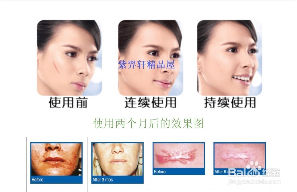 欣疤克祛疤真的有用吗?