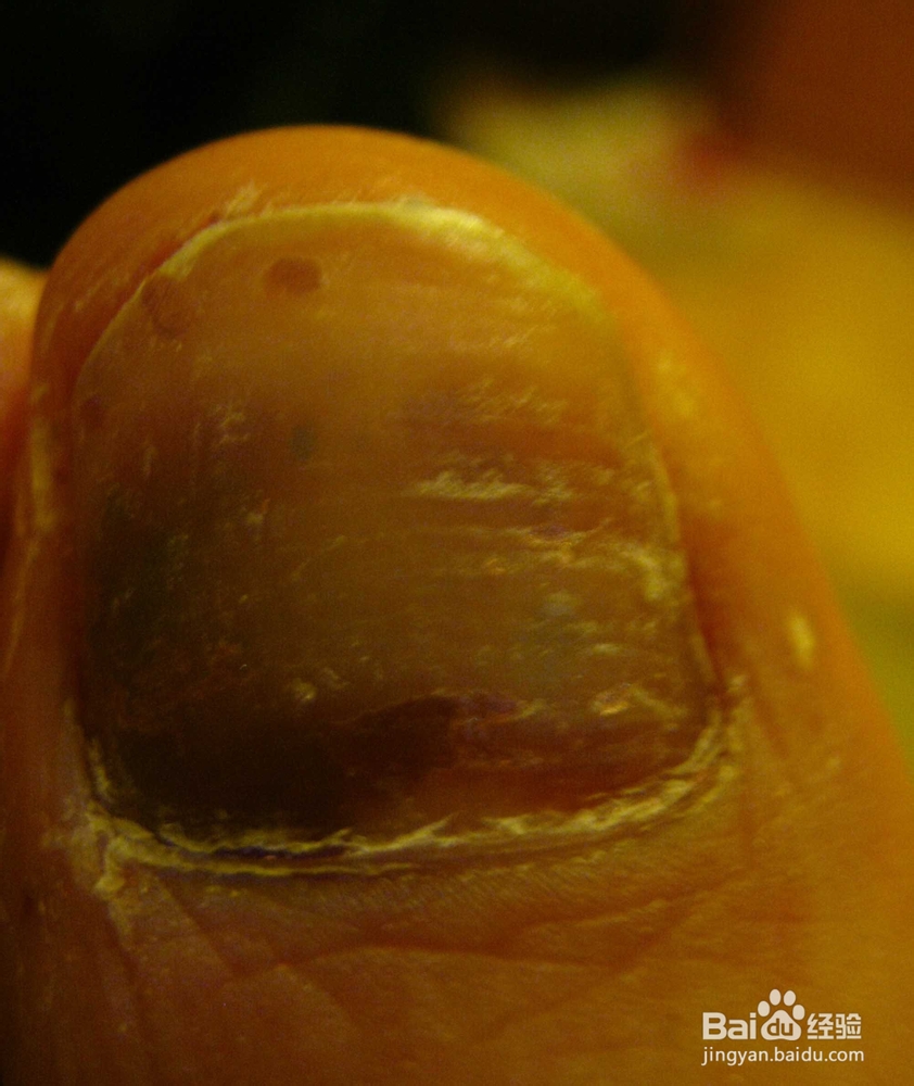 最常见的四种灰指甲治疗方法免费分享