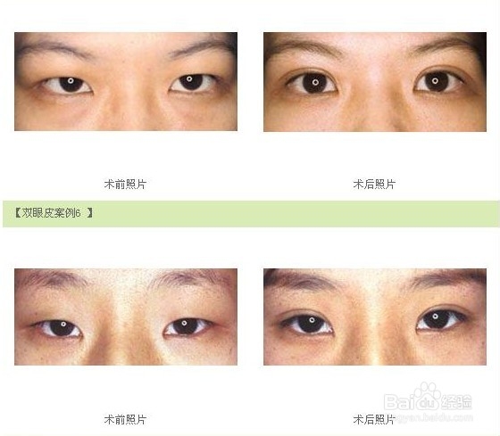 埋线双眼皮几天消肿