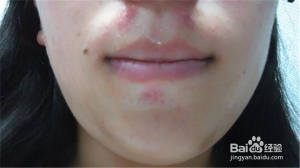 身体出现哪些信号是提醒要注意保护您的肾脏