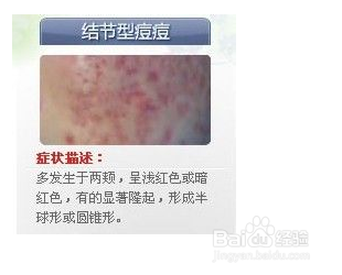 世上最全面治疗痘痘大全