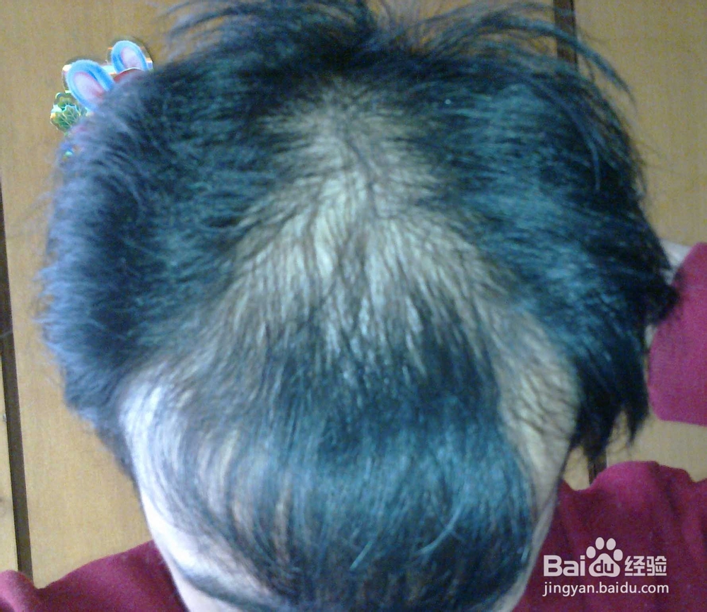 平时如何防止脱发