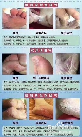 怎样识别不同类型的脚气