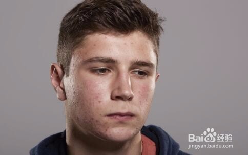 阴囊湿疹是什么回事